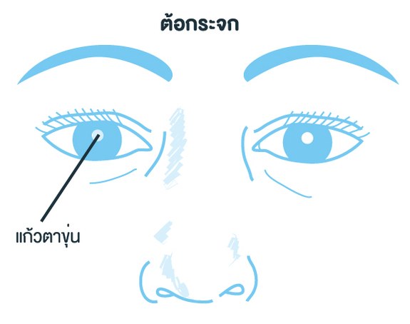 โรคต้อกระจก (Cataract )