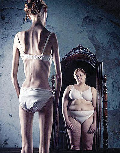 โรคกลัวอ้วน (Anorexia Nervosa)