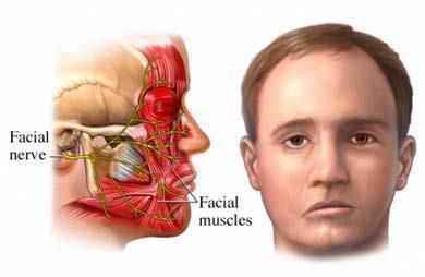 โรคหน้าเบี้ยวครึ่งซีก Bell's palsy