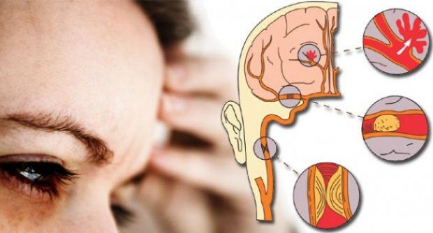 โรคสมองขาดเลือด Ischemic stroke 