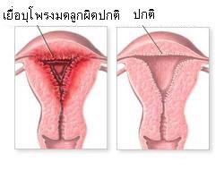 เยื่อบุโพรงมดลูกเจริญผิดที่