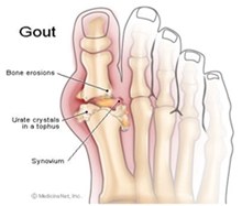 โรคเก๊าท์ คืออะไร?
