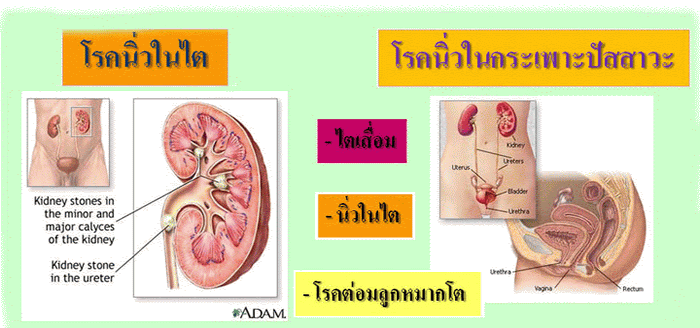 นิ่วในไต